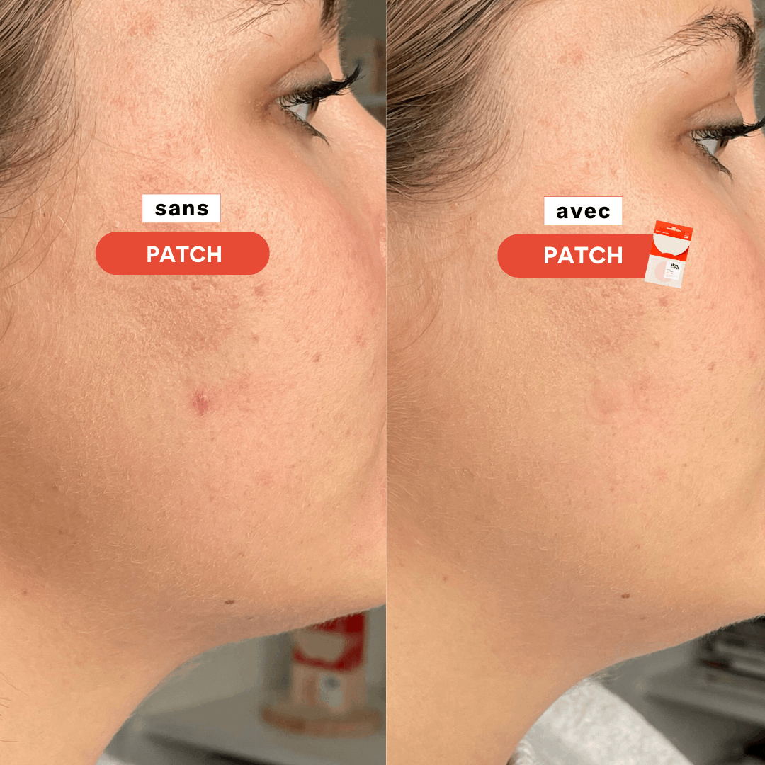 CLEAR OUT Patchs stop-boutons x23